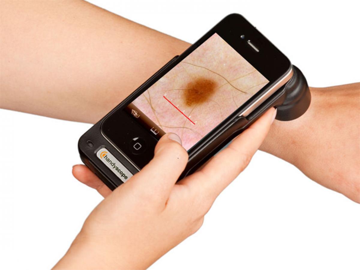 Simple smartphone device to catch skin cancer early